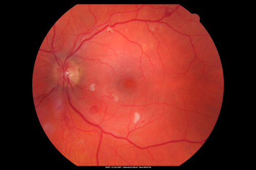 Hypertensive Retinopathy with Choroidal Ischemia Right Eye and Vision 8/200 - Blood Pressure 240/120 mmHg  IgA Nephropathy
39-year-old man two days ago he noticed poor vision in his right eye OD:  8/200;  OS:   20/20.   BP is 240/120
Keywords: cotton wool spot;serous retinal detachment;hypertensive;ischemia