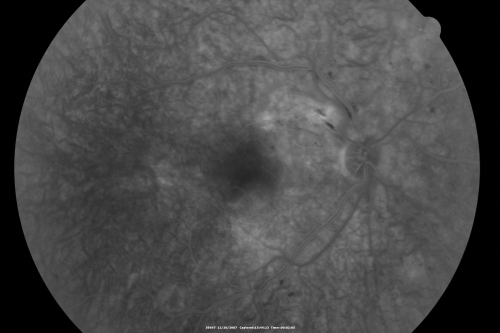 Hypertensive Retinopathy with Choroidal Ischemia Right Eye and Vision 8/200 - Blood Pressure 240/120 mmHg  IgA Nephropathy
39-year-old man two days ago he noticed poor vision in his right eye OD:  8/200;  OS:   20/20.   BP is 240/120
Keywords: cotton wool spot;serous retinal detachment;hypertensive;ischemia