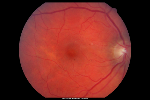 Hypertensive Retinopathy One Year later with good Vision   IgA Nephropathy
OD 20/30, OS 20/25 One year following initial episode.
