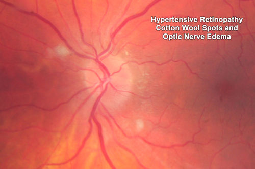 Malignant Hypertension - Cotton Wool Spots - Elschnig Spots - Optic Nerve Edema 
