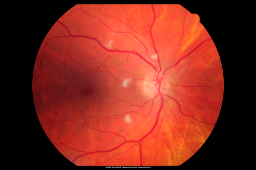 Malignant Hypertension - Cotton Wool Spots - Elschnig Spots - Optic Nerve Edema 
