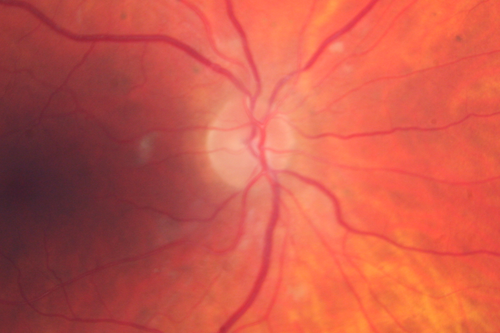Malignant Hypertension - Cotton Wool Spots - Elschnig Spots - Optic Nerve Edema 
6 week fu - CWS are Fading
