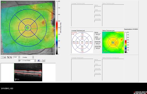 Malignant Hypertension - Cotton Wool Spots - Elschnig Spots - Optic Nerve Edema 
6 week fu - CWS are Fading
