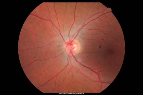 Hypertensive Choroidopathy - Pheochromocytoma - Chronic Very High Blood Pressure 49 YO Male
49-year-old man chronic very high blood pressure sometimes the blood pressure will go as high as 260/160, sometimes it is 200/120 and sometimes it is 160/80.  He has a pheochromocytoma on the adrenal gland and he has had vision loss in the right eye starting between three and four years ago.  

VISUAL ACUITY:  OD 20/60,  OS 20/25.
