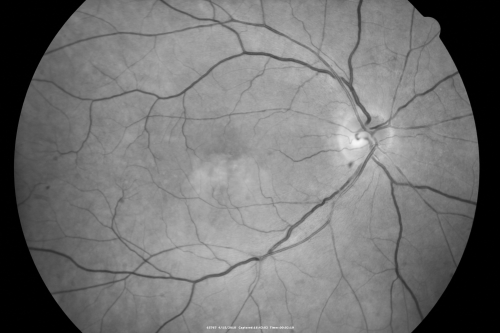 Hypertensive Choroidopathy - Pheochromocytoma - Chronic Very High Blood Pressure 49 YO Male
49-year-old man chronic very high blood pressure sometimes the blood pressure will go as high as 260/160, sometimes it is 200/120 and sometimes it is 160/80.  He has a pheochromocytoma on the adrenal gland and he has had vision loss in the right eye starting between three and four years ago.  

VISUAL ACUITY:  OD 20/60,  OS 20/25.
