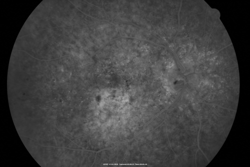 Hypertensive Choroidopathy - Pheochromocytoma - Chronic Very High Blood Pressure 49 YO Male
49-year-old man chronic very high blood pressure sometimes the blood pressure will go as high as 260/160, sometimes it is 200/120 and sometimes it is 160/80.  He has a pheochromocytoma on the adrenal gland and he has had vision loss in the right eye starting between three and four years ago.  

VISUAL ACUITY:  OD 20/60,  OS 20/25.

