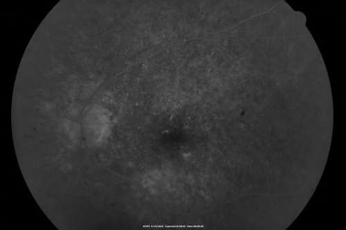 Hypertensive Choroidopathy - Pheochromocytoma - Chronic Very High Blood Pressure 49 YO Male
49-year-old man chronic very high blood pressure sometimes the blood pressure will go as high as 260/160, sometimes it is 200/120 and sometimes it is 160/80.  He has a pheochromocytoma on the adrenal gland and he has had vision loss in the right eye starting between three and four years ago.  

VISUAL ACUITY:  OD 20/60,  OS 20/25.
