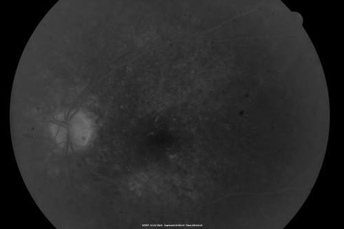 Hypertensive Choroidopathy - Pheochromocytoma - Chronic Very High Blood Pressure 49 YO Male
49-year-old man chronic very high blood pressure sometimes the blood pressure will go as high as 260/160, sometimes it is 200/120 and sometimes it is 160/80.  He has a pheochromocytoma on the adrenal gland and he has had vision loss in the right eye starting between three and four years ago.  

VISUAL ACUITY:  OD 20/60,  OS 20/25.
