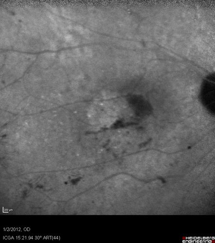 Post-Retinal Detachment Repair Occult Subfoveal CNVM
This pleasant 56-year-old man has had a complex retinal detachment repair in the right eye.  I most recently removed his silicone oil 3 months ago.  His vision now is the best it has ever been. 
VISUAL ACUITY:  OD 4/200

