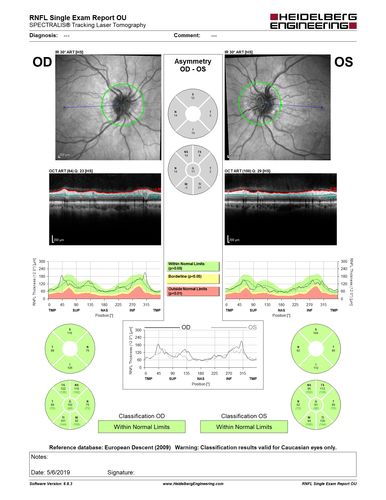 Papilledema - Benign Intracranial hypertension - Idiopathic intracranial hypertension
35 year old obese female.  Normal vision and headache.  Opening pressure was 30 cm water (normal 10-20).  Nerve swelling responded to diamox.

