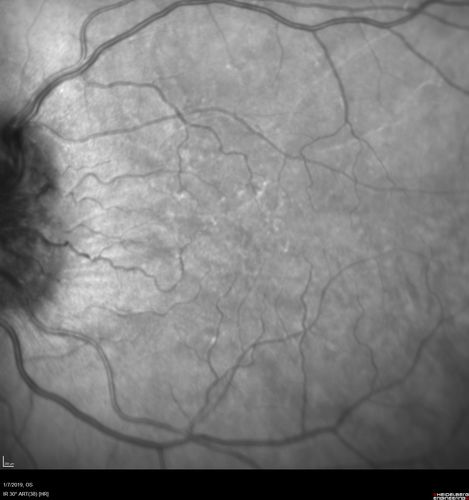 Papilledema - Benign Intracranial hypertension - Idiopathic intracranial hypertension
35 year old obese female.  Normal vision and headache.  Opening pressure was 30 cm water (normal 10-20).  Nerve swelling responded to diamox.
