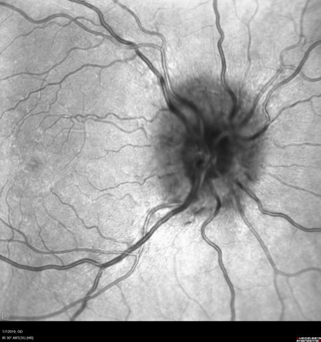 Papilledema - Benign Intracranial hypertension - Idiopathic intracranial hypertension
35 year old obese female.  Normal vision and headache.  Opening pressure was 30 cm water (normal 10-20).  Nerve swelling responded to diamox.
