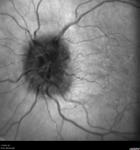 Papilledema - Benign Intracranial hypertension - Idiopathic intracranial hypertension
35 year old obese female.  Normal vision and headache.  Opening pressure was 30 cm water (normal 10-20).  Nerve swelling responded to diamox.

