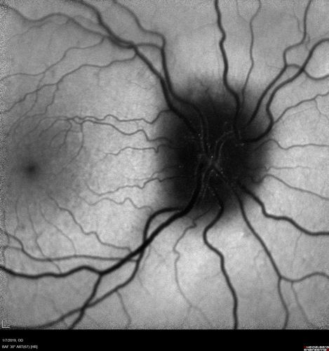Papilledema - Benign Intracranial hypertension - Idiopathic intracranial hypertension
35 year old obese female.  Normal vision and headache.  Opening pressure was 30 cm water (normal 10-20).  Nerve swelling responded to diamox.
