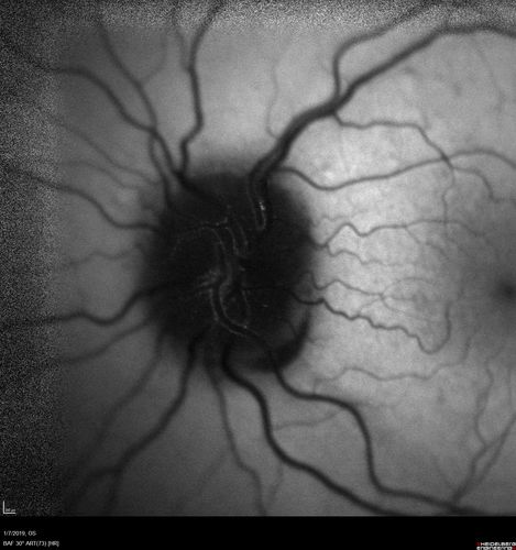 Papilledema - Benign Intracranial hypertension - Idiopathic intracranial hypertension
35 year old obese female.  Normal vision and headache.  Opening pressure was 30 cm water (normal 10-20).  Nerve swelling responded to diamox.
