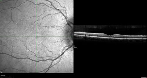 Papilledema - Benign Intracranial hypertension - Idiopathic intracranial hypertension
35 year old obese female.  Normal vision and headache.  Opening pressure was 30 cm water (normal 10-20).  Nerve swelling responded to diamox.
