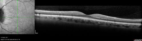 Papilledema - Benign Intracranial hypertension - Idiopathic intracranial hypertension
35 year old obese female.  Normal vision and headache.  Opening pressure was 30 cm water (normal 10-20).  Nerve swelling responded to diamox.
