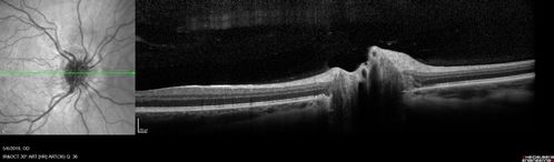 Papilledema - Benign Intracranial hypertension - Idiopathic intracranial hypertension
35 year old obese female.  Normal vision and headache.  Opening pressure was 30 cm water (normal 10-20).  Nerve swelling responded to diamox.
