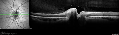 Papilledema - Benign Intracranial hypertension - Idiopathic intracranial hypertension
35 year old obese female.  Normal vision and headache.  Opening pressure was 30 cm water (normal 10-20).  Nerve swelling responded to diamox.
