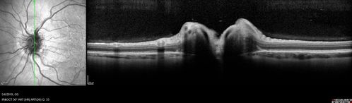 Papilledema - Benign Intracranial hypertension - Idiopathic intracranial hypertension
35 year old obese female.  Normal vision and headache.  Opening pressure was 30 cm water (normal 10-20).  Nerve swelling responded to diamox.
