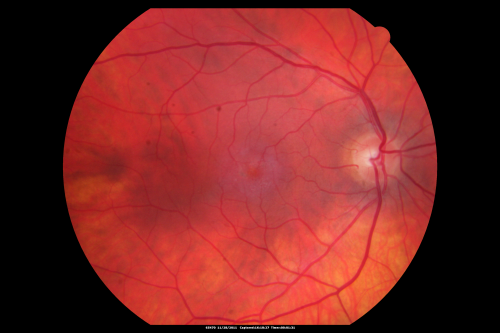 Juxtafoveal Telangiectasis - Stage 5 Left Eye - New Blood and Neovascularization MacTel 
60-year-old man has juxtafoveal retinal telangiectasis recent vision loss OD 20/50,  OS 20/70 : Hemorrhage OS and new SRNVM
