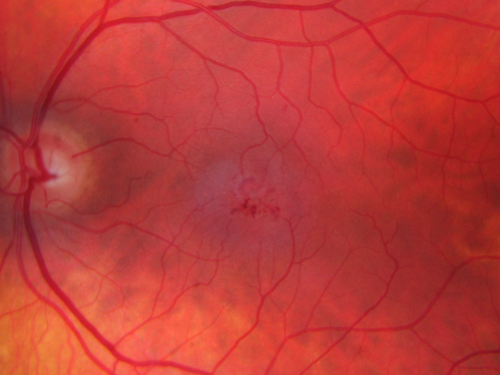 Juxtafoveal Telangiectasis - Stage 5 Left Eye - New Blood and Neovascularization MacTel 
60-year-old man has juxtafoveal retinal telangiectasis recent vision loss OD 20/50,  OS 20/70 : Hemorrhage OS and new SRNVM
