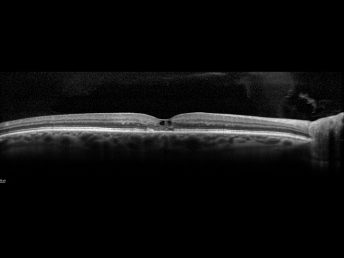 Juxtafoveal Telangiectasis - Stage 5 Left Eye - New Blood and Neovascularization MacTel SDOCT
60-year-old man has juxtafoveal retinal telangiectasis recent vision loss OD 20/50,  OS 20/70 : Hemorrhage OS and new SRNVM
