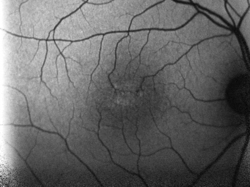 Juxtafoveal Telangiectasis - Stage 5 Left Eye - New Blood and Neovascularization MacTel FAF
60-year-old man has juxtafoveal retinal telangiectasis recent vision loss OD 20/50,  OS 20/70 : Hemorrhage OS and new SRNVM
