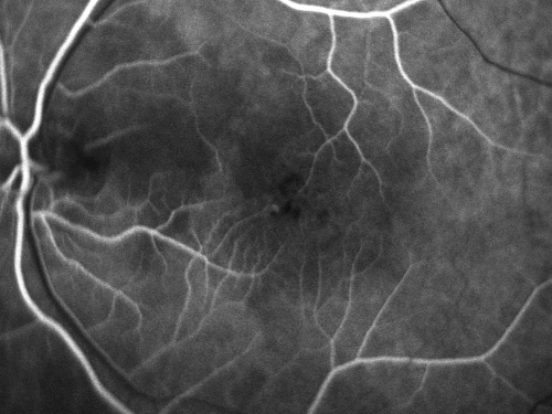 Juxtafoveal Telangiectasis - Stage 5 Left Eye - New Blood and Neovascularization MacTel 
60-year-old man has juxtafoveal retinal telangiectasis recent vision loss OD 20/50,  OS 20/70 : Hemorrhage OS and new SRNVM
