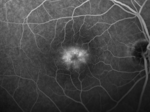 Juxtafoveal Telangiectasis - Stage 5 Left Eye - New Blood and Neovascularization MacTel 
60-year-old man has juxtafoveal retinal telangiectasis recent vision loss OD 20/50,  OS 20/70 : Hemorrhage OS and new SRNVM
