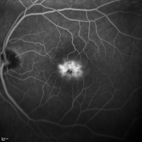 Juxtafoveal Telangiectasis - Stage 5 Left Eye - New Blood and Neovascularization MacTel 
60-year-old man has juxtafoveal retinal telangiectasis recent vision loss OD 20/50,  OS 20/70 : Hemorrhage OS and new SRNVM

