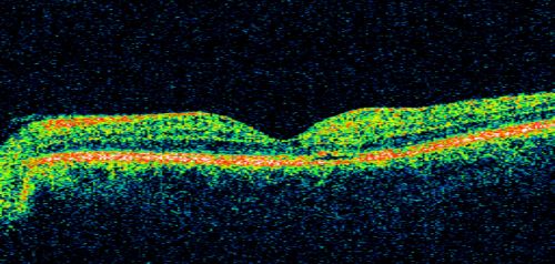 Juxtafoveal Telangiectasis - MacTel - Retinal Telangiectasis - Both Eyes - Crystals
61-year-old man has idiopathic juxtafoveal retinal telangiectasis type II in both eyes  OD is 20/40, OS is 20/25

