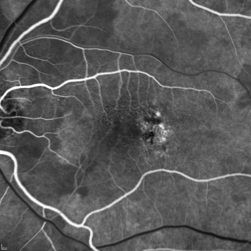 Group 2a Juxtafoveal Telangiectasis - MacTel - Stage 5 left eye - Macular Hole Right eye
76-year-old woman has juxtafoveal retinal telangiectasis.  She had Stage five neovascularization in the left eye I treated with injections between September of 2007 and October of 2008 with Avastin (3 years ago).  OCT scan today shows macular hole right eye. VISUAL ACUITY:  OD 20/400,  OS 20/40. 

