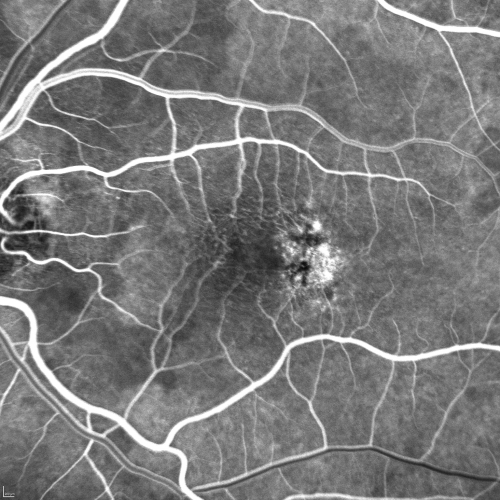 Group 2a Juxtafoveal Telangiectasis - MacTel - Stage 5 left eye - Macular Hole Right eye
76-year-old woman has juxtafoveal retinal telangiectasis.  She had Stage five neovascularization in the left eye I treated with injections between September of 2007 and October of 2008 with Avastin (3 years ago).  OCT scan today shows macular hole right eye. VISUAL ACUITY:  OD 20/400,  OS 20/40. 

