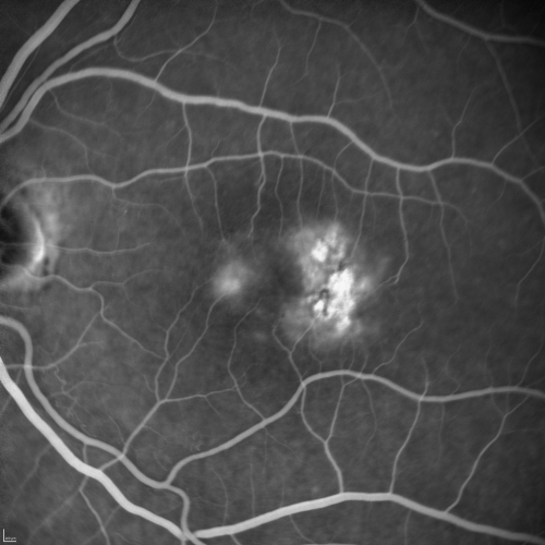 Group 2a Juxtafoveal Telangiectasis - MacTel - Stage 5 left eye - Macular Hole Right eye
76-year-old woman has juxtafoveal retinal telangiectasis.  She had Stage five neovascularization in the left eye I treated with injections between September of 2007 and October of 2008 with Avastin (3 years ago).  OCT scan today shows macular hole right eye. VISUAL ACUITY:  OD 20/400,  OS 20/40. 
