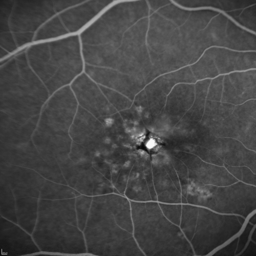 Group 2a Juxtafoveal Telangiectasis - MacTel - Stage 5 left eye - Macular Hole Right eye
76-year-old woman has juxtafoveal retinal telangiectasis.  She had Stage five neovascularization in the left eye I treated with injections between September of 2007 and October of 2008 with Avastin (3 years ago).  OCT scan today shows macular hole right eye. VISUAL ACUITY:  OD 20/400,  OS 20/40. 
