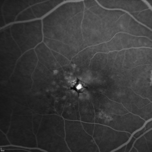 Group 2a Juxtafoveal Telangiectasis - MacTel - Stage 5 left eye - Macular Hole Right eye
76-year-old woman has juxtafoveal retinal telangiectasis.  She had Stage five neovascularization in the left eye I treated with injections between September of 2007 and October of 2008 with Avastin (3 years ago).  OCT scan today shows macular hole right eye. VISUAL ACUITY:  OD 20/400,  OS 20/40. 
