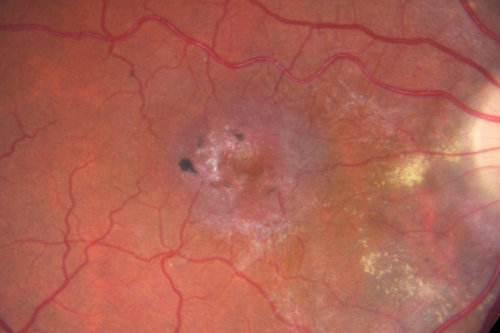 Juxtfoveal Telangiectasis Group 2a - Type II - MacTel - also Juxtapapillary Asymptomatic CNVM Right Eye
82-year-old woman who has juxtafoveal retinal telangiectasis in both eyes.  She recently had cataract surgery in the right eye and the vision in the right eye is still limited.   OD 20/100, OS 20/40.
