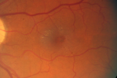 Juxtfoveal Telangiectasis Group 2a - Type II - MacTel - also Juxtapapillary Asymptomatic CNVM Right Eye
82-year-old woman who has juxtafoveal retinal telangiectasis in both eyes.  She recently had cataract surgery in the right eye and the vision in the right eye is still limited.   OD 20/100, OS 20/40.
