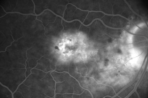 Juxtfoveal Telangiectasis Group 2a - Type II - MacTel - also Juxtapapillary Asymptomatic CNVM Right Eye
82-year-old woman who has juxtafoveal retinal telangiectasis in both eyes.  She recently had cataract surgery in the right eye and the vision in the right eye is still limited.   OD 20/100, OS 20/40.
