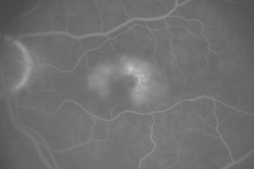 Juxtfoveal Telangiectasis Group 2a - Type II - MacTel - also Juxtapapillary Asymptomatic CNVM Right Eye
82-year-old woman who has juxtafoveal retinal telangiectasis in both eyes.  She recently had cataract surgery in the right eye and the vision in the right eye is still limited.   OD 20/100, OS 20/40.
