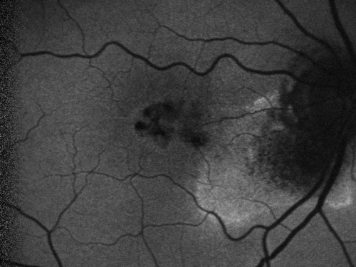 Juxtafoveal Telangiectasis (MacTel) and Asymptomatic Extrafoveal Juxtapapillary Choroidal Neovascular Membrane Fundus Autofluorescence
84-year-old woman has juxtafoveal retinal telangiectasis in both eyes.  The right eye has an asymptomatic extra foveal juxtapapillary choroidal neovascular membrane.    OD 20/400,  OS 20/63.
