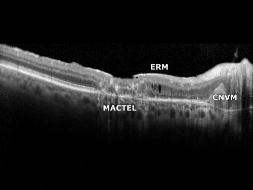 Juxtafoveal Telangiectasis (MacTel) and Asymptomatic Extrafoveal Juxtapapillary Choroidal Neovascular Membrane
84-year-old woman has juxtafoveal retinal telangiectasis in both eyes.  The right eye has an asymptomatic extra foveal juxtapapillary choroidal neovascular membrane.    OD 20/400,  OS 20/63.
