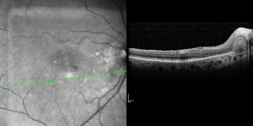 Juxtafoveal Telangiectasis (MacTel) and Asymptomatic Extrafoveal Juxtapapillary Choroidal Neovascular Membrane
84-year-old woman has juxtafoveal retinal telangiectasis in both eyes.  The right eye has an asymptomatic extra foveal juxtapapillary choroidal neovascular membrane.    OD 20/400,  OS 20/63.
