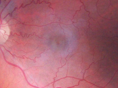 Juxtafoveal Retinal Telangiectasia (Telangiectasis) - MacTel - Striking Gray Ring in Macula
59-year-old woman decreasing vision in the right eye for a few years.  She has had diabetes for five years.  OD 20/100,  Pinhole 20/40.  OS 20/20
