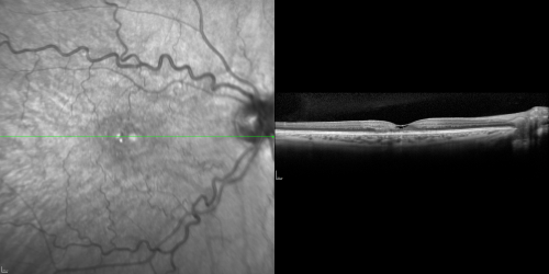 Juxtafoveal Retinal Telangiectasia (Telangiectasis) - MacTel - Striking Gray Ring in Macula - SDOCT
59-year-old woman decreasing vision in the right eye for a few years.  She has had diabetes for five years.  OD 20/100,  Pinhole 20/40.  OS 20/20
