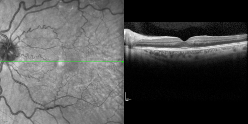 Juxtafoveal Retinal Telangiectasia (Telangiectasis) - MacTel - Striking Gray Ring in Macula - SDOCT
59-year-old woman decreasing vision in the right eye for a few years.  She has had diabetes for five years.  OD 20/100,  Pinhole 20/40.  OS 20/20
