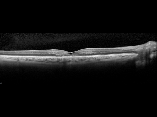 Juxtafoveal Retinal Telangiectasia (Telangiectasis) - MacTel - Striking Gray Ring in Macula - SDOCT
59-year-old woman decreasing vision in the right eye for a few years.  She has had diabetes for five years.  OD 20/100,  Pinhole 20/40.  OS 20/20
