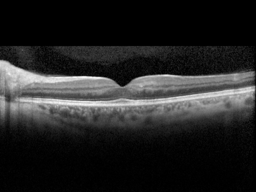 Juxtafoveal Retinal Telangiectasia (Telangiectasis) - MacTel - Striking Gray Ring in Macula - SDOCT
59-year-old woman decreasing vision in the right eye for a few years.  She has had diabetes for five years.  OD 20/100,  Pinhole 20/40.  OS 20/20
