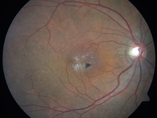 Juxtafoveal Telangiectasis - After Hemorrhage Absorbed Right Eye with Avastin Injections
73-year-old woman has juxtafoveal retinal telangiectasis in both eyes.  The right eye has stage 5 disease.  Her last Avastin treatment in the right eye was in 6 months ago.  The right eye has been the worst of her two eyes for years.

VISUAL ACUITY: Vision OD is 20/200, OS is 20/50.  

